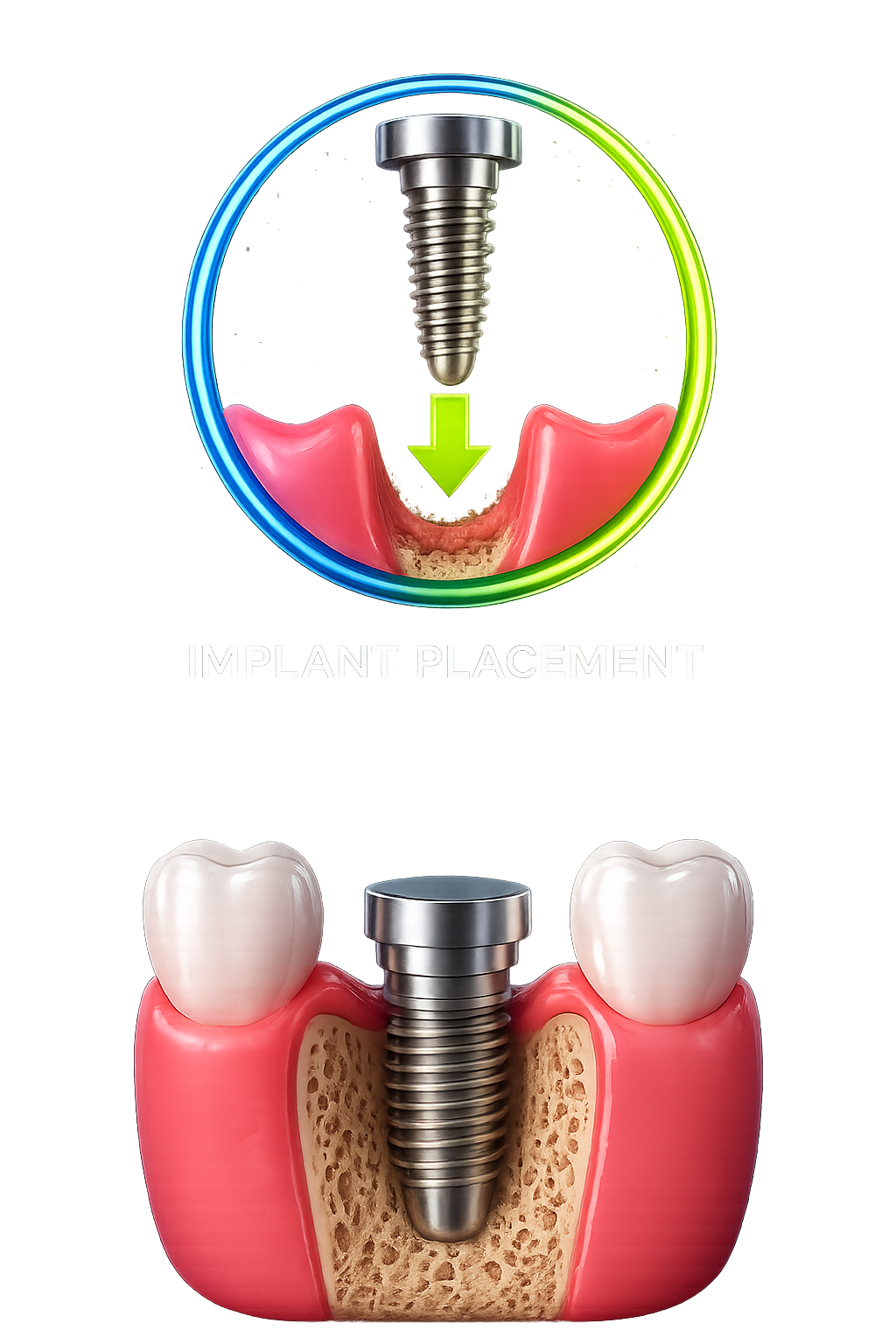 Dental Implant Placement
